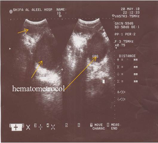 Case Report Diagnosing Of Imperforate Hymen By Ultrasound Science Publishing Group