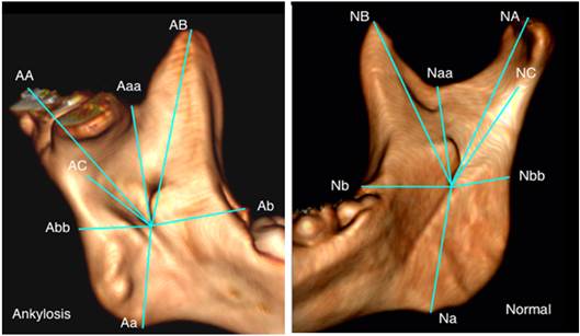 Effect Of Temporomandibular Joint Bony Ankylosis On Location Of The Mandibular Foramen Science Publishing Group