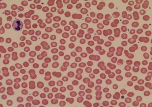 Complete Blood Cell Count and Peripheral Blood Film, Its Significant in ...